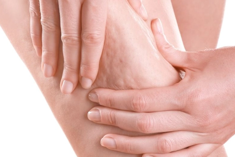 Prof. Dr. Karacalar&rsquo;dan sel&uuml;lit uyarısı: Portakal kabuğu g&ouml;r&uuml;nt&uuml;s&uuml; basit sorun değil!